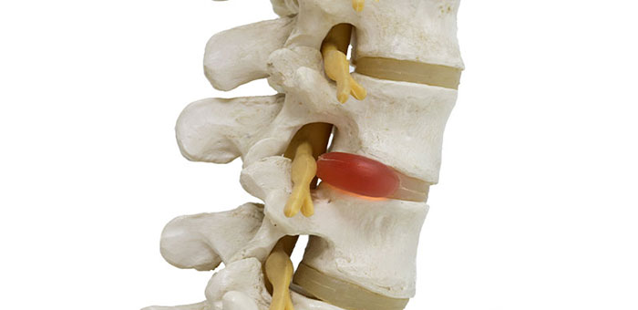 Herniated disc in spine before visiting Concord chiropractor