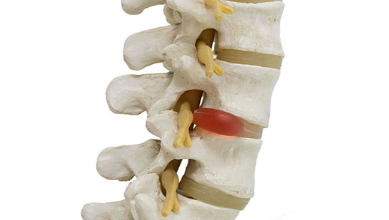 Herniated disc in spine before visiting Concord chiropractor