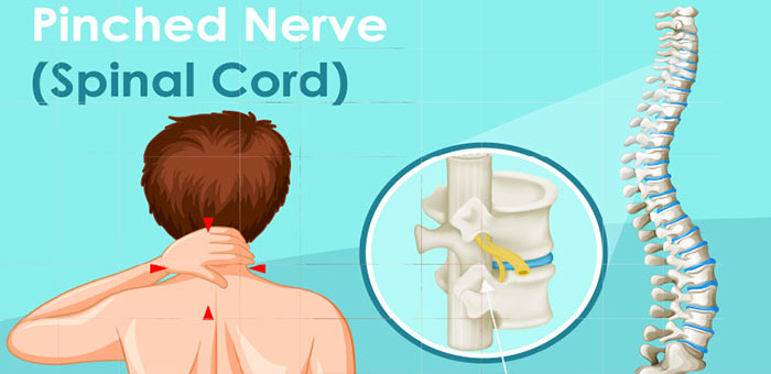 Pinched nerve in spine before chiropractic treatment from Concord chiropractor