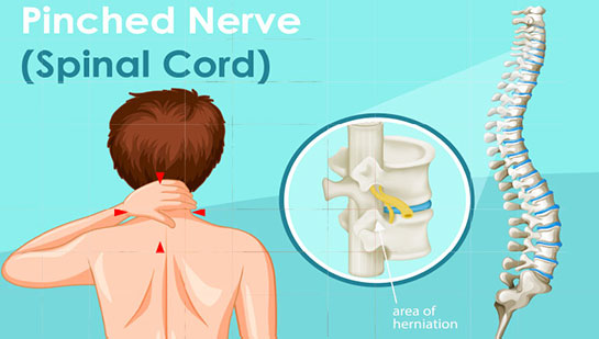 Pinched nerve in spine before chiropractic treatment from Concord chiropractor