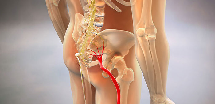 Sciatic nerve pain before chiropractic treatment from Concord chiropractor