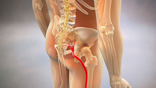 Sciatic nerve pain before chiropractic treatment from Concord chiropractor