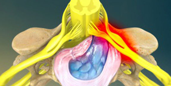 Herniated Disc Concord